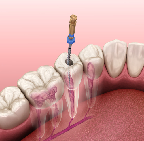 Cap sur l’endodontie