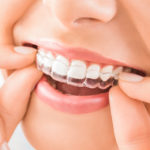 Invisalign-DentisteToul